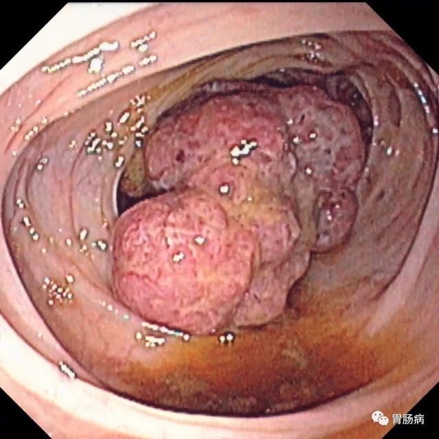这样的大便,可能是大肠癌来临! (转载)