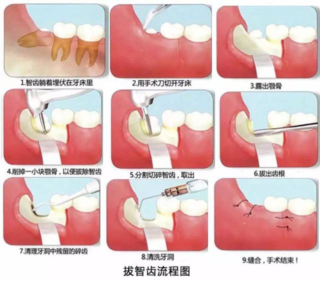 智齿疼起来苦不堪言,究竟该不该拔?口腔医生这样说