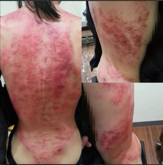 图片可见痧像,肝区结节比较多,都是颜色比较重的痧包,八髎结节也是成