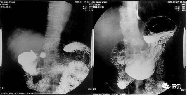 胃肠道常见病影像表现:胃溃疡,消化道肿瘤,肠结核