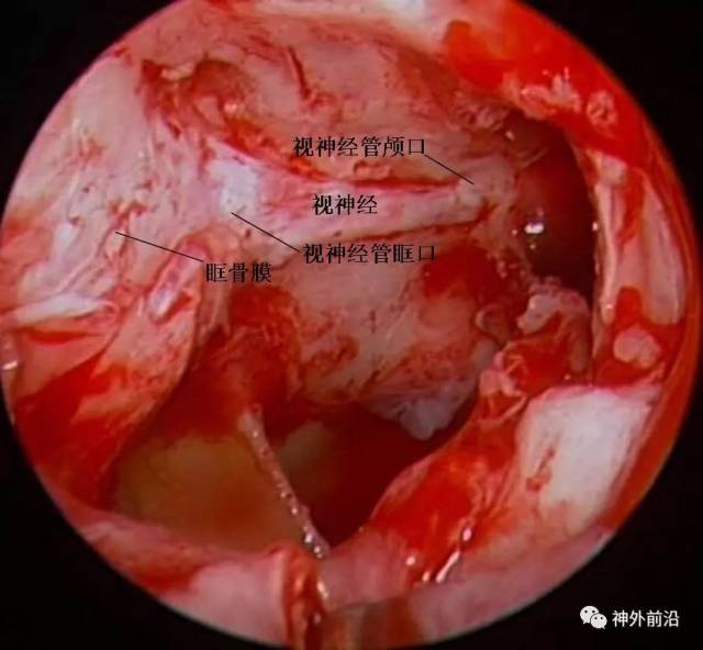 手术视频 同仁医院康军 内镜经鼻入路眶视神经管区病变的手术治疗