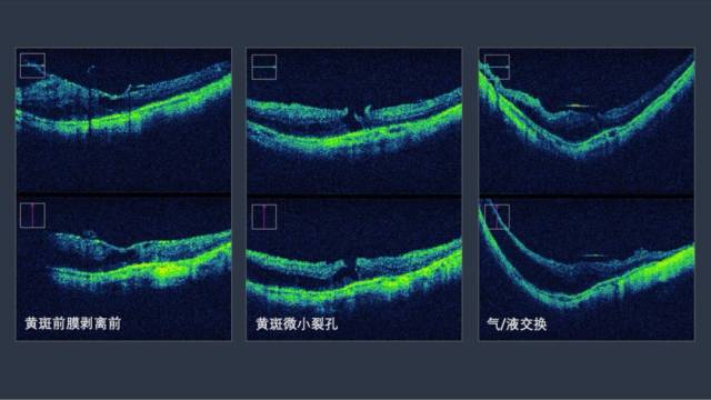 张淳教授通过4例术中oct导航修复微小黄斑裂孔手术,展示应用术中oct