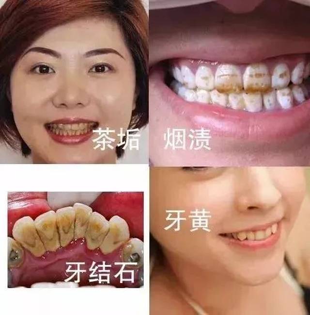 不仅满口黄牙,有的人张嘴还飘散一股 迷之口臭