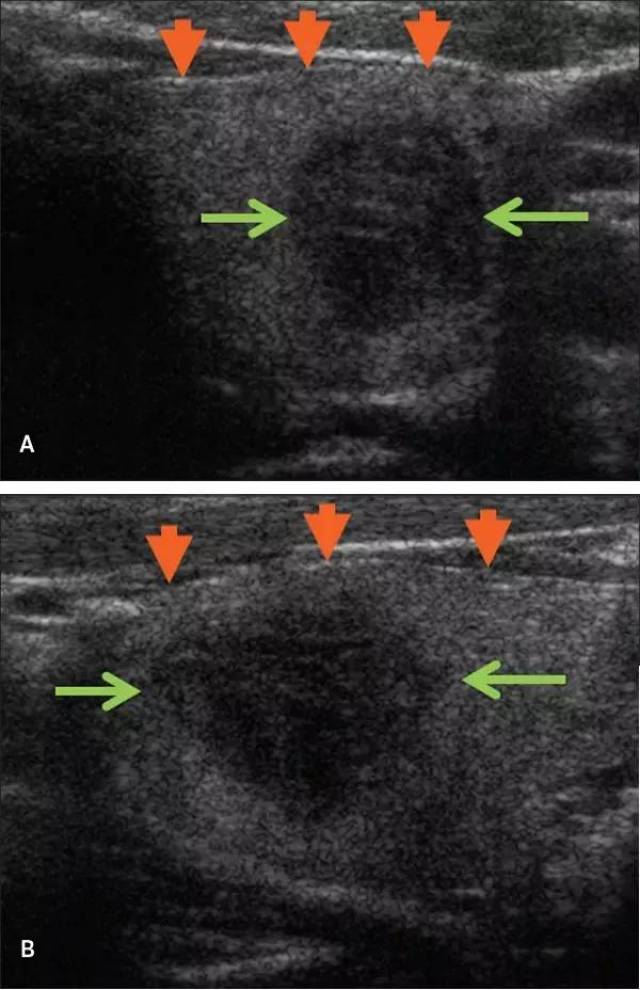 超声:甲状腺乳头状癌被膜外浸润