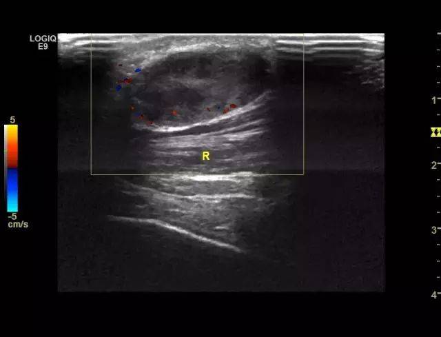 高手进阶:腱鞘巨细胞瘤的超声表现_手机搜狐网