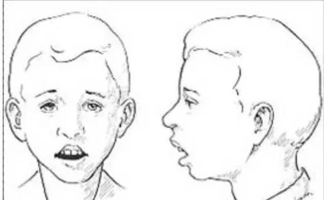 面容: 上唇较短 开唇露齿,有时嘴唇有外翻倾向 8,口腔溃疡/扁桃体/腺
