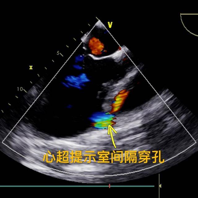 室间隔穿孔作为急性心肌梗死后严重的并发症之一,可导致血流动力学的
