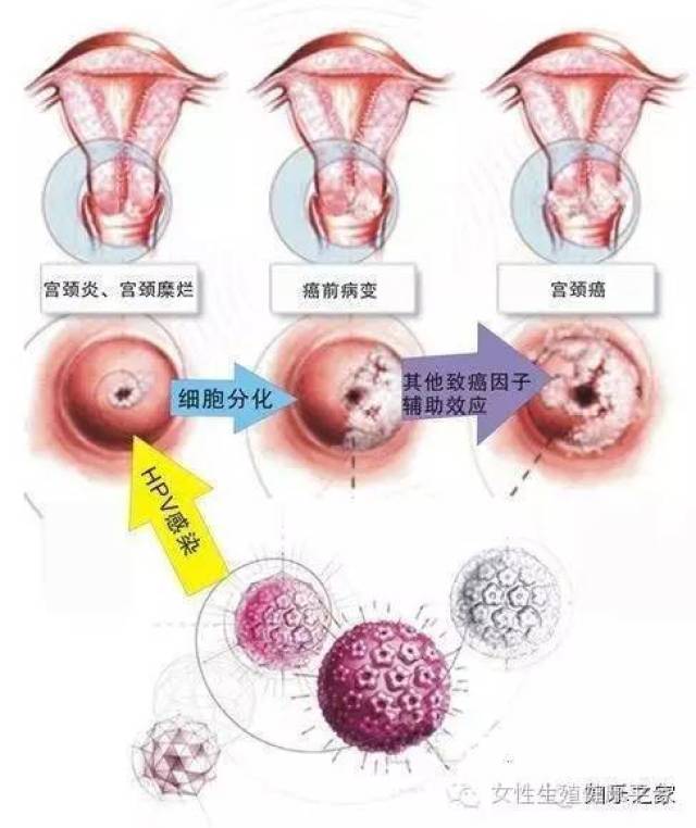 什么是hpv病毒?传播途径?