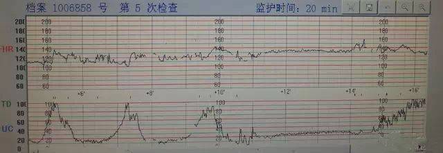 患者宫口开大 3 cm,因静滴缩宫素过快,造成宫缩较强,胎心慢时在 90