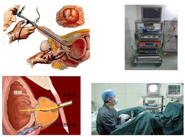 泌尿外科等离子手术系统如何开拓国际市场?