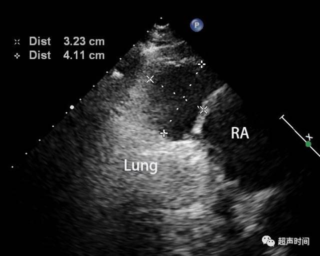 心包囊肿的超声诊断