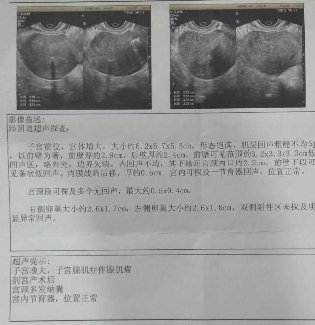 曼月乐环不是腺肌症的救命稻草