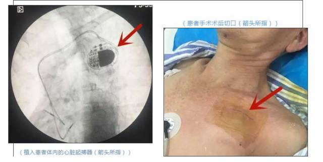 4个靖西喜讯,人民医院成功开展首例永久性心脏起搏器植入术.