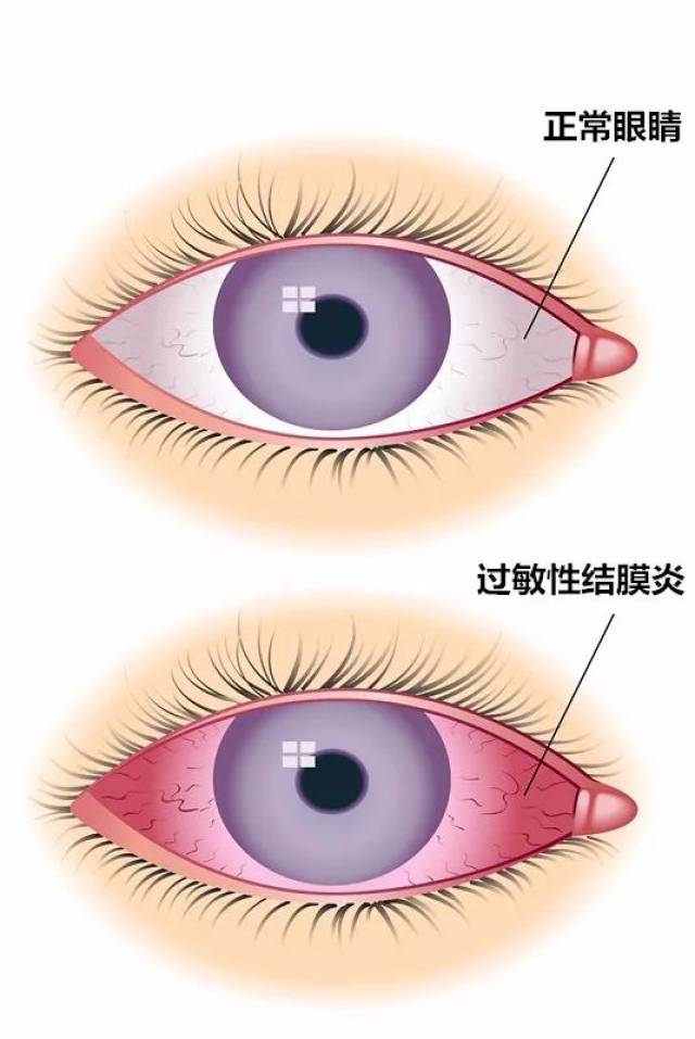 眼红,眼肿,发痒,眼屎还多?可能是过敏性结膜炎找上门了.