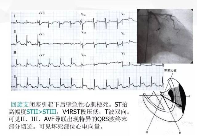 心电图定位心肌梗死部位流程图