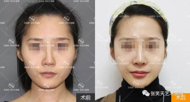 下颌角截骨 颧骨内推术后9个月