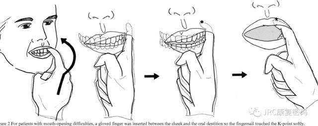 对于没有开口困难的患者,用压舌板轻触k点以促进吞咽(下图),刺激后10