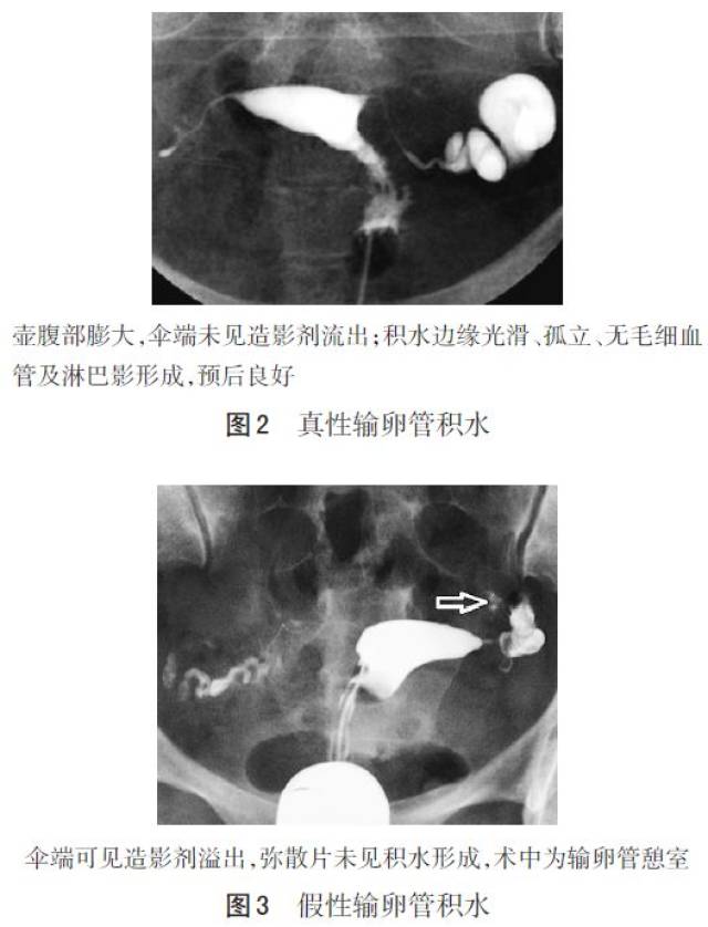 子宫输卵管造影的图像解读