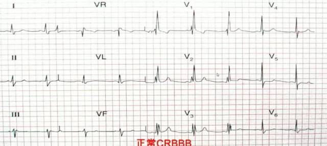 急性心梗6种不典型心电图:不可忽视的改变
