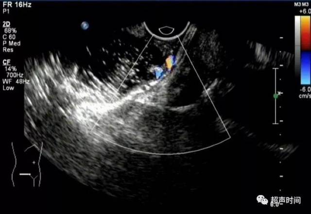 胃肠超声疑难病例(11):诡异的直肠肠壁结节