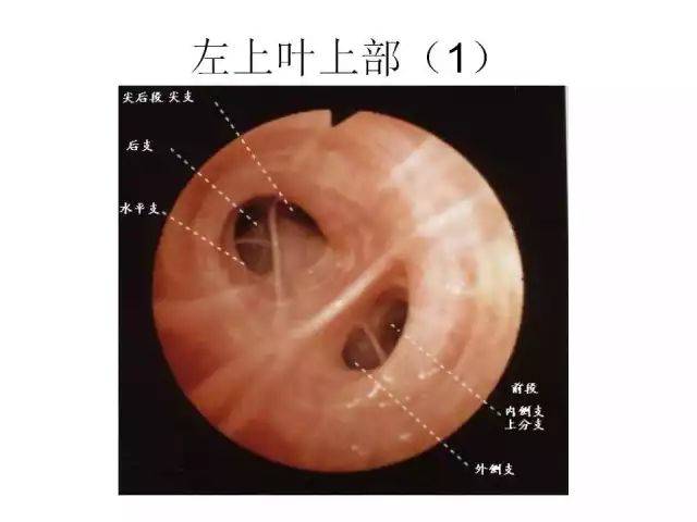 你弄懂气道支气管的解剖结构了吗?