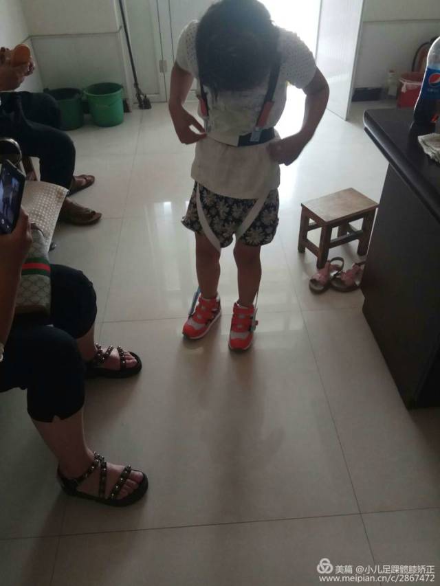 对于比较严重的内八字脚儿童晚上可以加配外展支架,这样白天,晚上同时