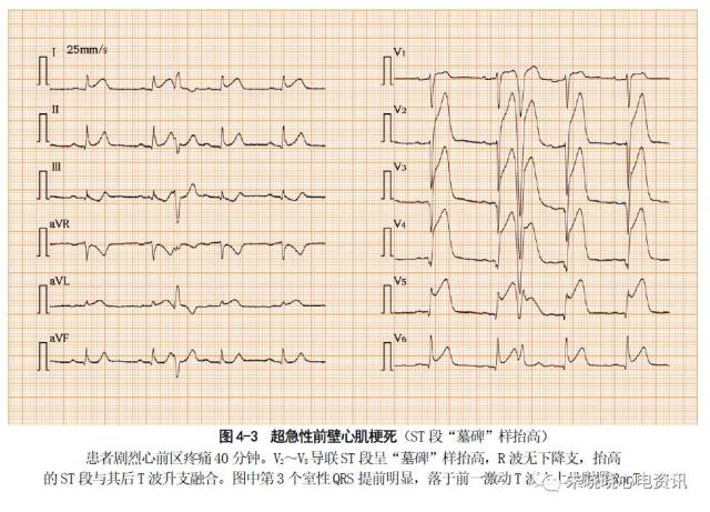 【张新民老师心电系列】第四讲:心电图对心肌梗死的诊断价值