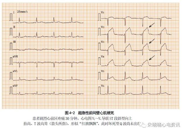 t波  t波增高变尖,直立高耸的t波是此期心电图最主要的改变(图4-2)