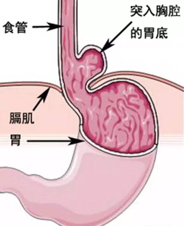 食管裂孔疝是什么病?严重吗? (转载)