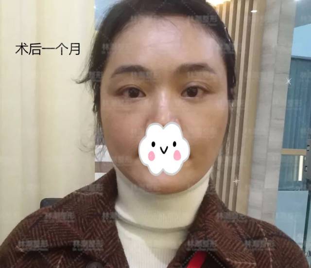 术式:自体脂肪填充上眼窝