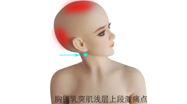 莫名其妙的头顶痛,真凶原来是.