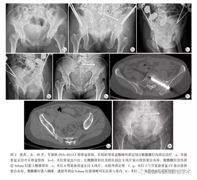 新型骨盆髂嵴外固定结合骶髂螺钉内固定治疗ota-61c1.