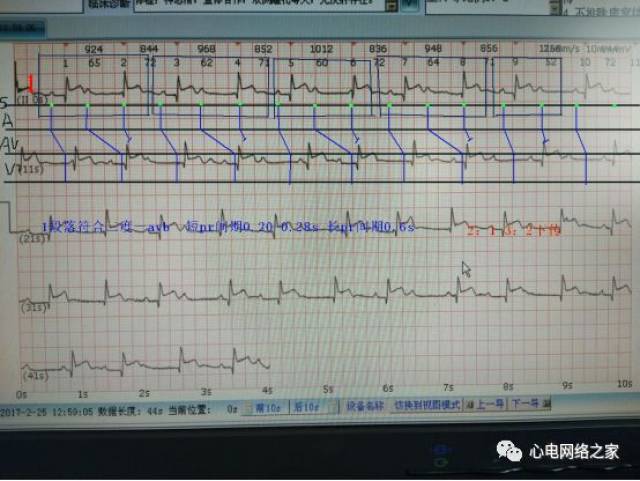 心电图实例解图系列98-下后壁右室梗心电系列