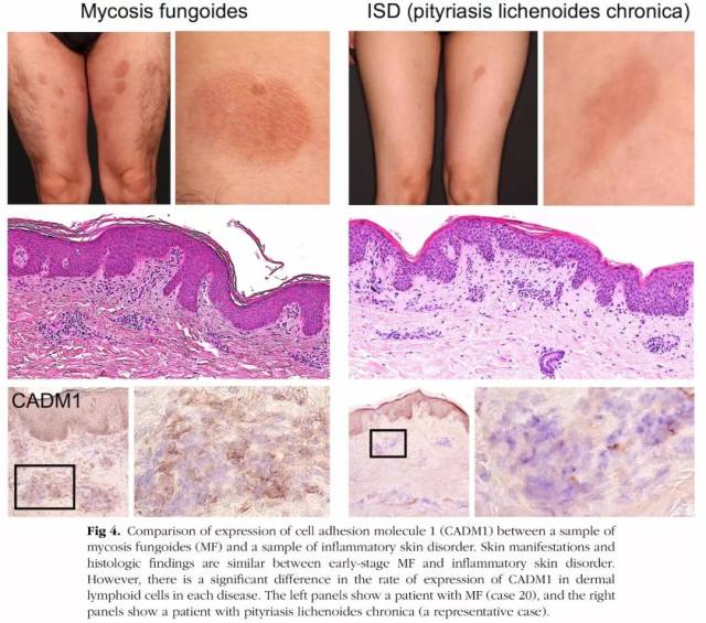 cadm1可用于区分蕈样肉芽肿与炎症性皮肤病