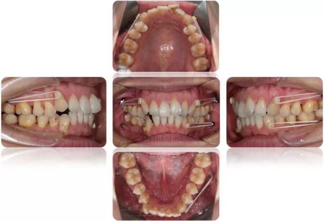 隐形矫治十强病例丨上下推磨牙远移解除拥挤改善前凸