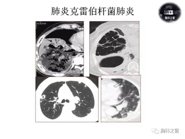 金黄色葡萄球菌肺炎的影像学表现