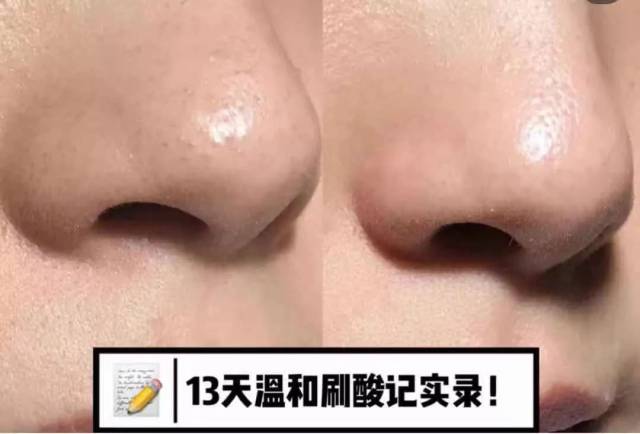 刷酸|谈"酸"色变,有的人早就不要脸了