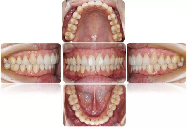 隐形矫治十强病例丨上下推磨牙远移解除