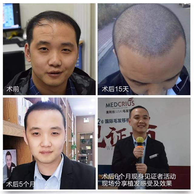 植发两年后,不仅人年轻了至少10岁,心态上也一改往日的忧郁,变得阳光