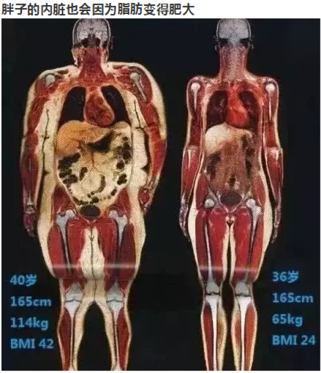 内脏如果附着过多的甘油三酯,就会形成 内脏脂肪型肥胖.