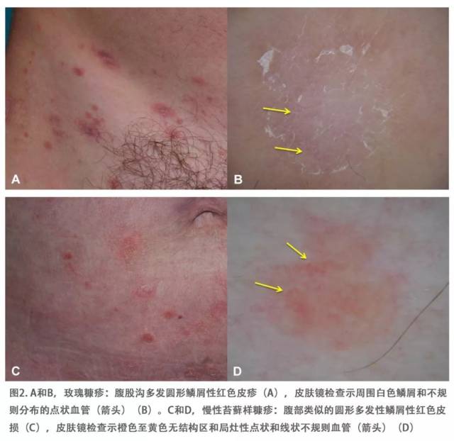 皮肤镜检查可迅速与点滴型银屑病[60](图1c和d)及慢性苔藓样糠疹