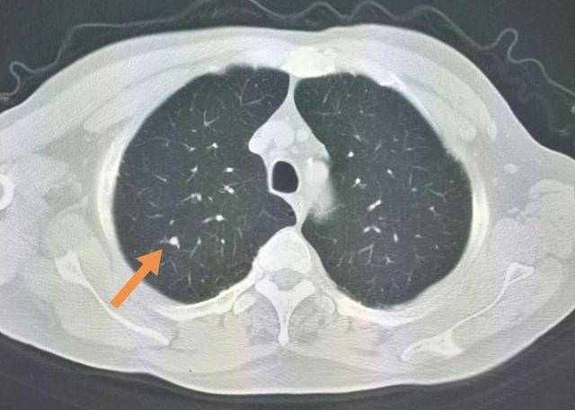 像这位老人,首次检查发现右肺小结节,很光滑,直径0.5cm.
