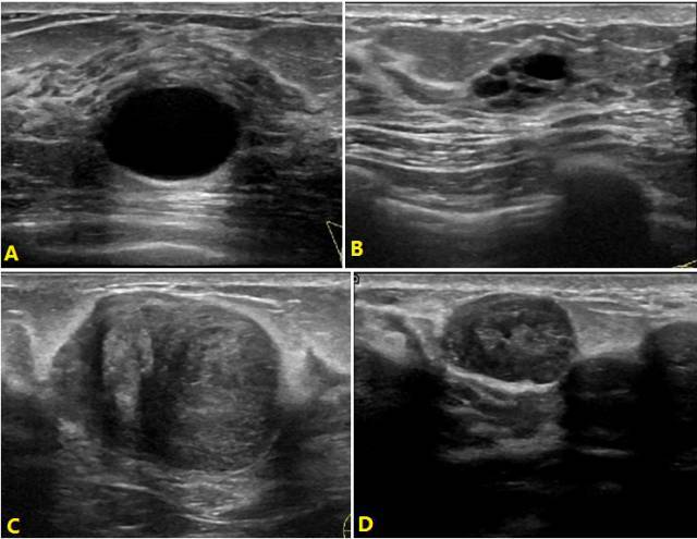 岳林先主任解读第 5 版乳腺超声 bi-rads 分类