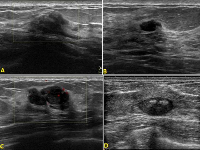 岳林先主任解读第 5 版乳腺超声 BI-RADS 分类