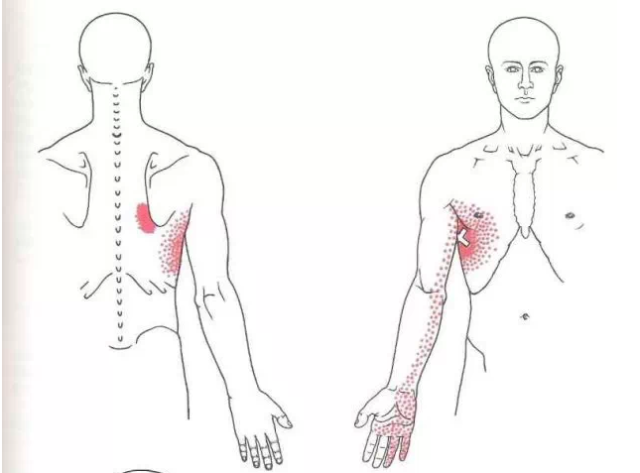 肩胛骨内侧缘疼痛的治疗