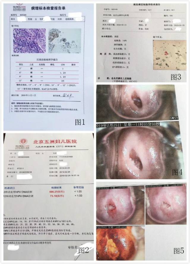 北京五洲妇儿医院妇科专家李蔚范:宫颈癌的hpv感染不可小觑