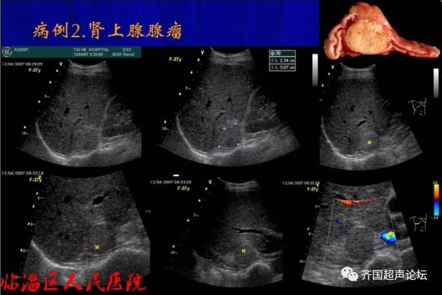 【基础】肾上腺正常声像图及常见疾病超声表现