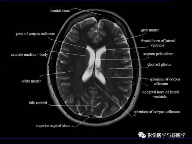 【影像解剖】头颅mr横断面解剖中英文对照