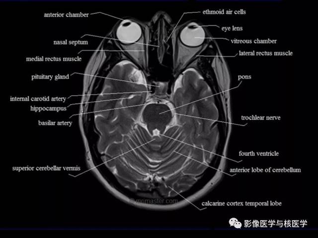 【影像解剖】头颅mr横断面解剖中英文对照