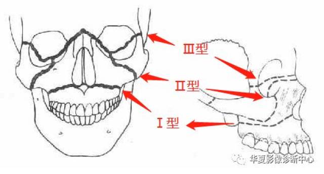 骨折发生在上颌骨的上薄弱线,从鼻额缝向两侧横过鼻梁,眶部,再经过颧